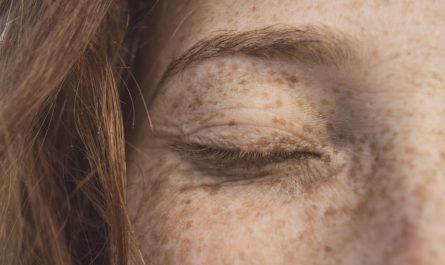 Kurie oká – ako sa zbaviť nepríjemného kožného problému