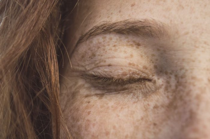 Kurie oká – ako sa zbaviť nepríjemného kožného problému